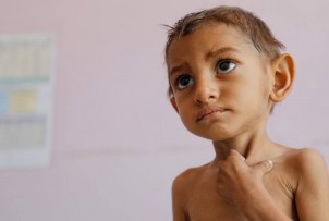 Dzieci w Jemenie umierają z głodu. Lekarze walczą o ich życie.