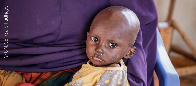 Wychudzony Farhan przed otrzymaniem pomocy od UNICEF.