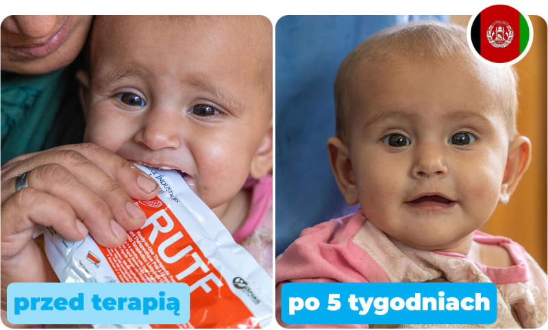 Somaya z Afganistanu: : po lewej zdjęcie wychudzonej dziewczynki na początku terapii pastą RUTF, po prawej zdjęcie tej samej dziewczynki po 5 tygodniach terapii.