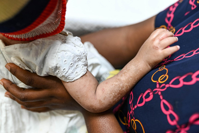 Globalne cięcia finansowania zagrażają postępom w walce z HIV