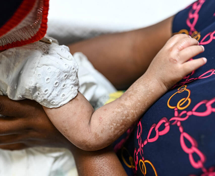 Globalne cięcia finansowania zagrażają postępom w walce z HIV