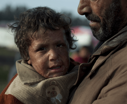 SYRIA: uratowany z płomieni 4-letni Adnan potrzebuje pomocy